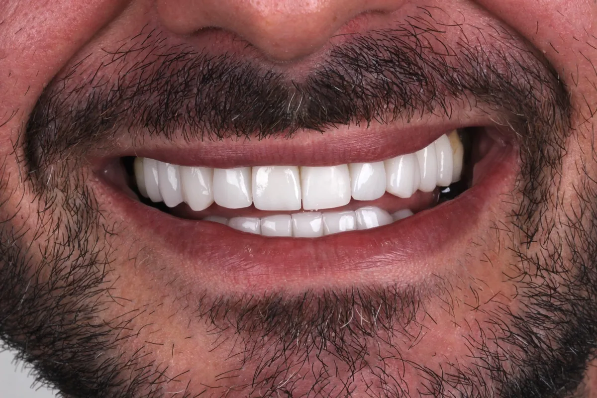 Sorriso depois do tratamento — caso 01