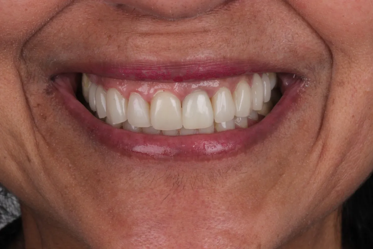 Sorriso antes do tratamento — caso 02