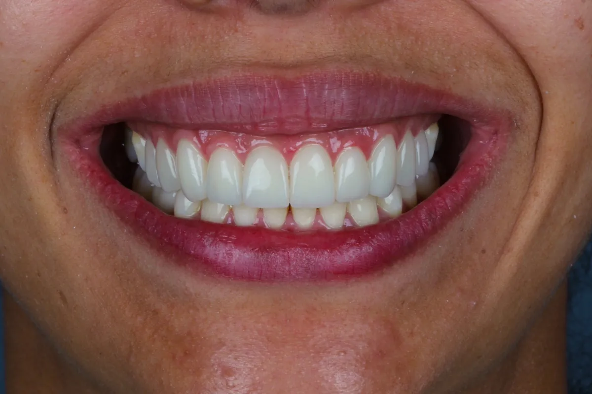 Sorriso depois do tratamento — caso 02