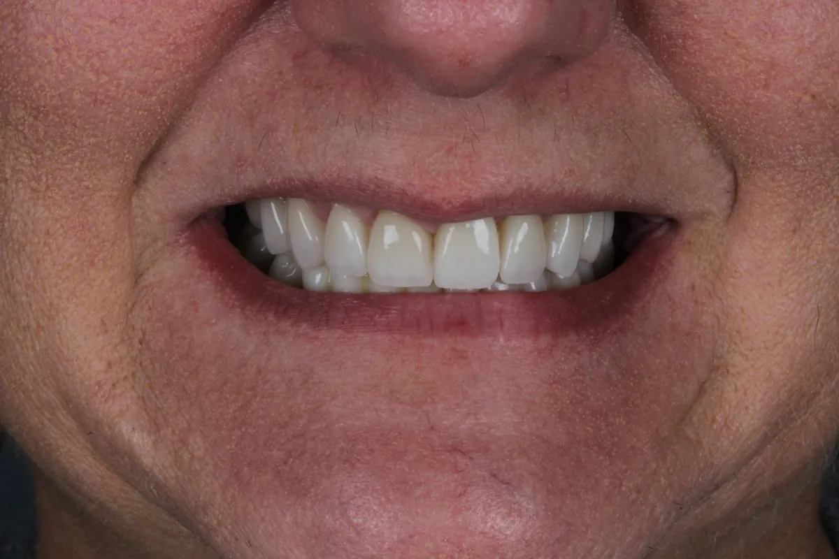Sorriso antes do tratamento — caso 03