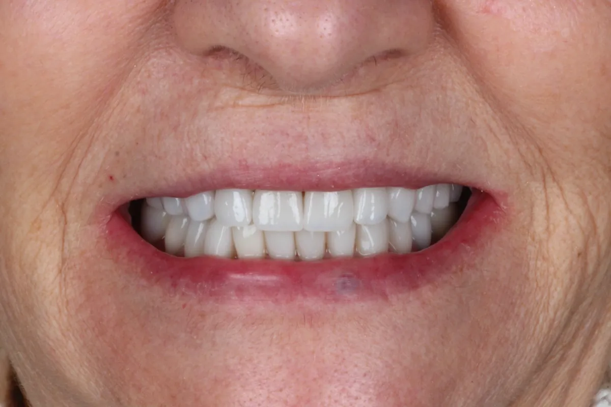 Sorriso depois do tratamento — caso 03