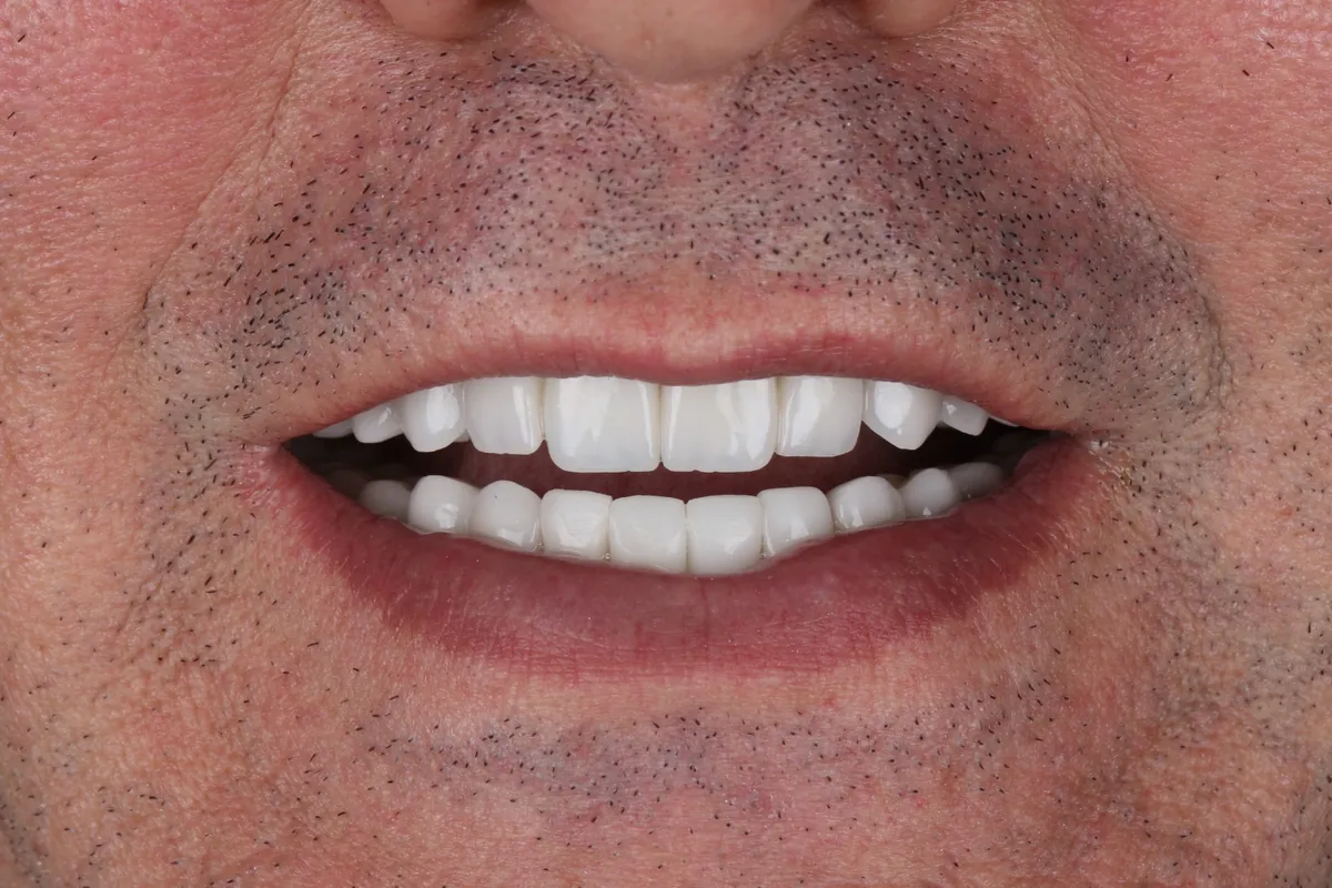 Sorriso antes do tratamento — caso 04
