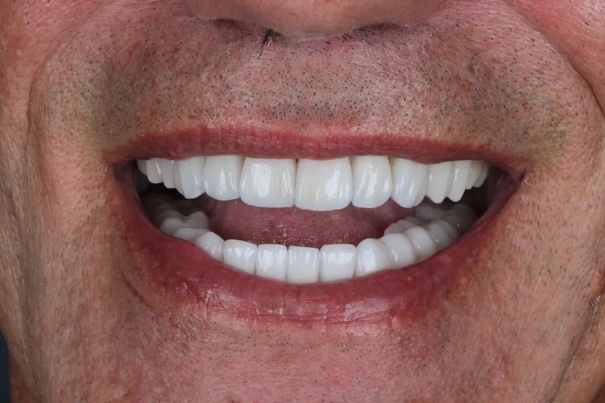 Sorriso depois do tratamento — caso 04