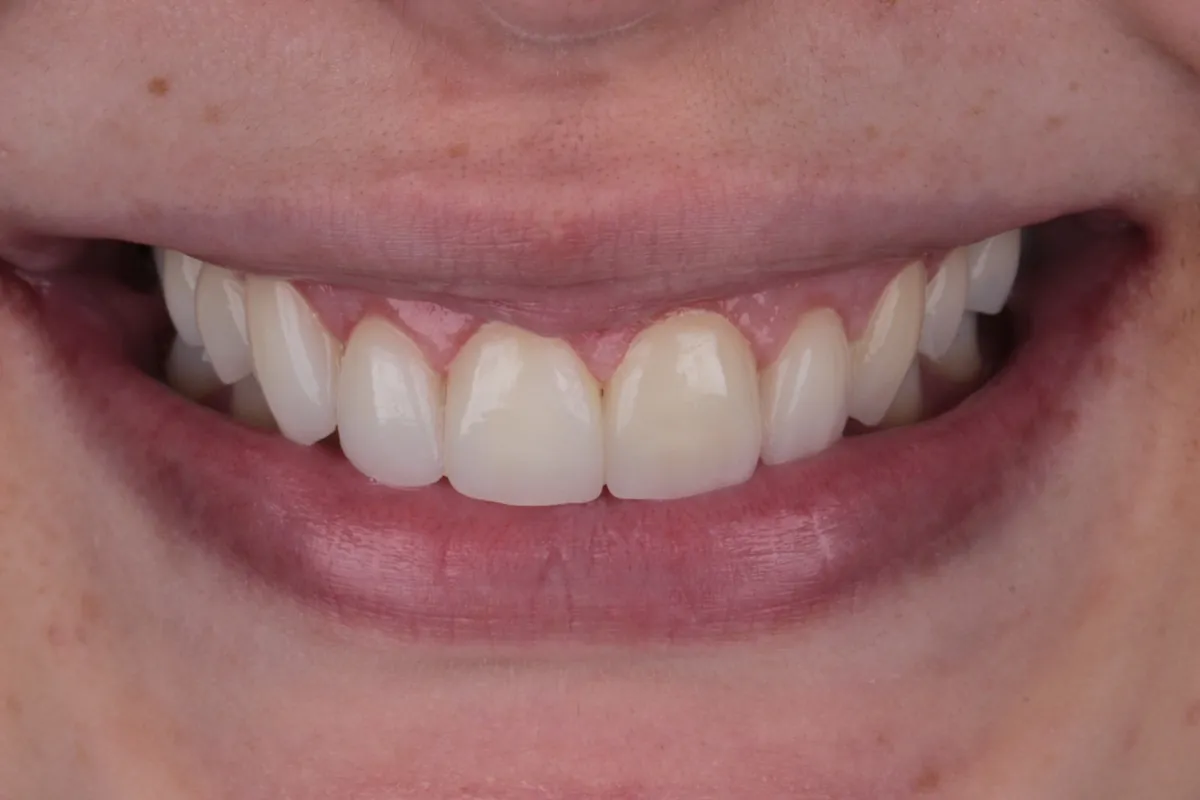Sorriso antes do tratamento — caso 05