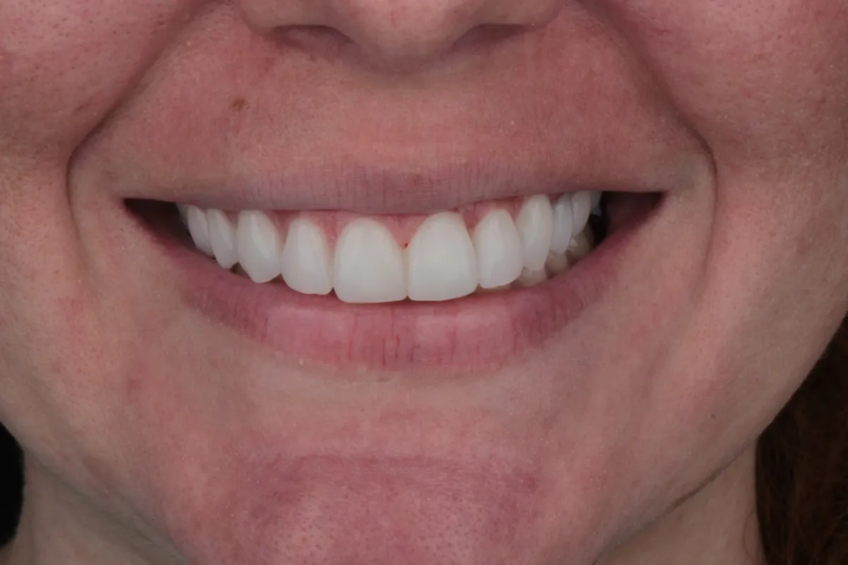 Sorriso depois do tratamento — caso 05