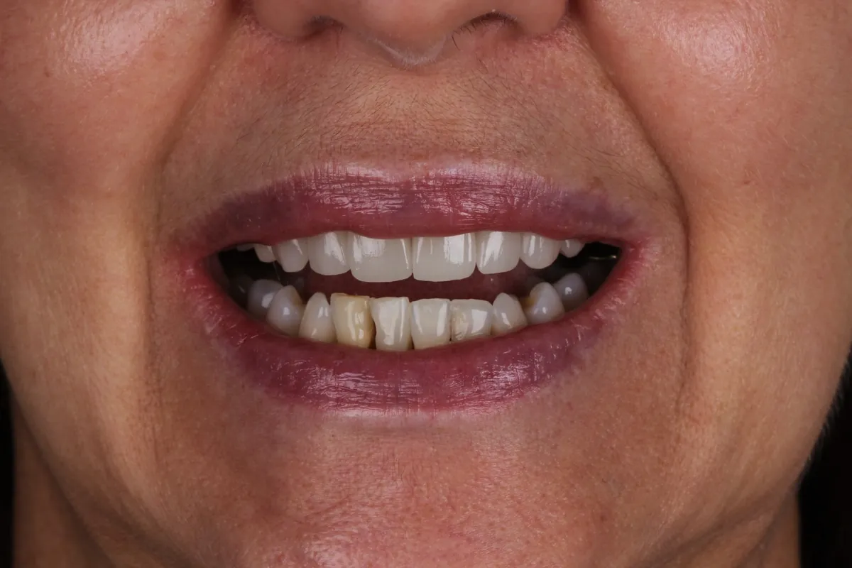Sorriso antes do tratamento — caso 06