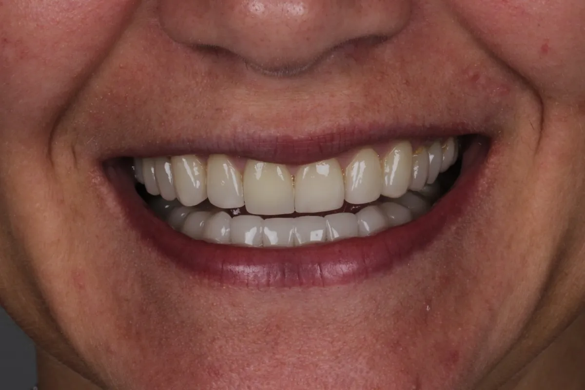 Sorriso depois do tratamento — caso 06